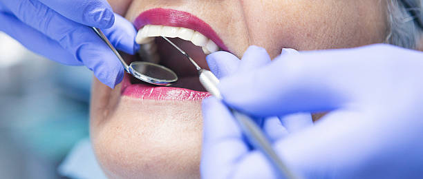 Best Knocked-Out Tooth (Avulsed Tooth) Treatment in River Ridge, LA